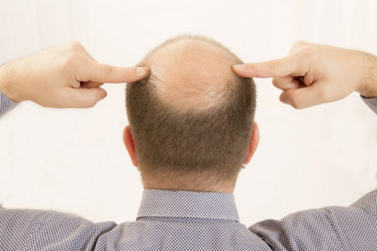 A Long-Lasting Treatment Option for Hair Restoration Without Surgery in IL