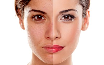 Unlock Glowing Skin with Microneedling at Luxe Beauty & Wellness in Creekside