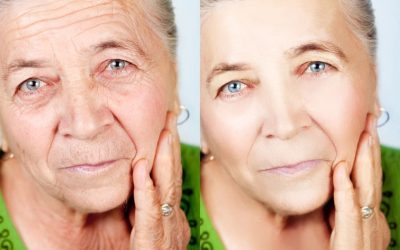 Sculptra Benefits and Treatment Expectations in Las Vegas